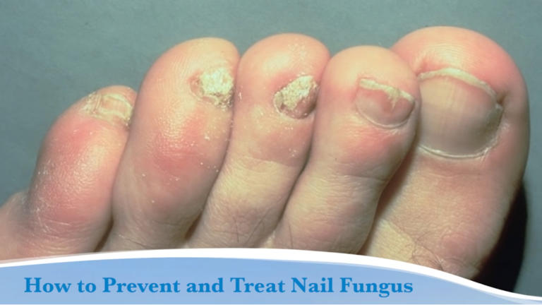 How to prevent and treat nail fungus